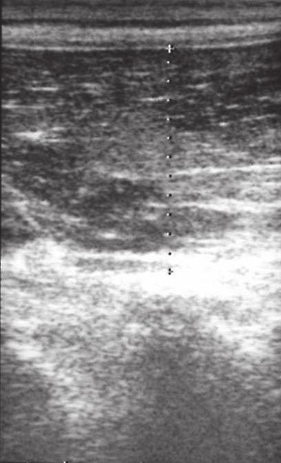 3 Measurement of ultrasound imaging of