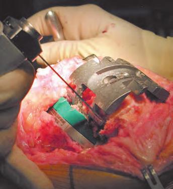 Augment Cuts With the TCG properly positioned, visually determine the appropriate