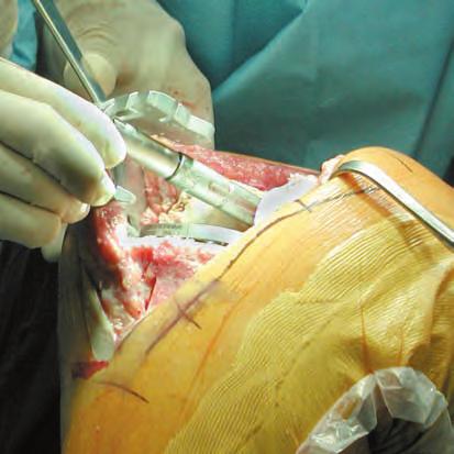 Tibial Canal Preparation 2.