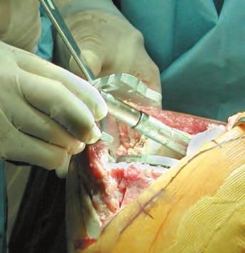 Trial Cutting Guide Orientation Note: Femoral chamfer cuts cannot be made with the TCG.
