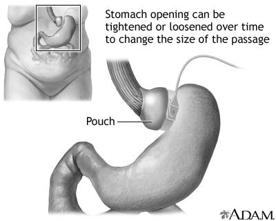 gov/medlineplus/ency/imagepages/ Medline Plus: Roux-en-Y stomach surgery for weight loss at http://www.