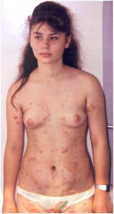 Atlas of women dermatology: from infant to maturity 88 Figure 9.