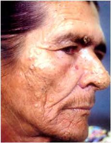 Atlas of women dermatology: from infant to maturity 110 Figure 12.