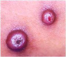 syndrome). DLP ID: actinic kemtosis 775.