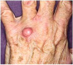 DLP ID: hypopigmented mycosis fungoides 2813.