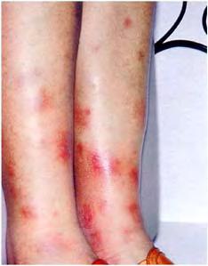 Cutaneous manifestations of systemic diseases