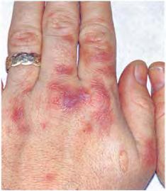 Cutaneous manifestations of systemic diseases 133
