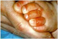 1 Diseases of newborns Figure 1.1 Acropustulosis, infantile.