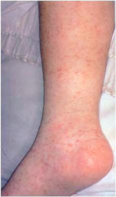 17 Rickettsial diseases Figure 17.1 Rocky Mountain spotted fever.