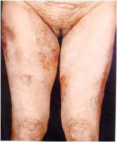 Atlas of women dermatology: from infant to maturity 174 Figure 19.