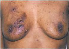 Diseases of the breast 207 Figure