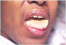 DLP ID: hand-foot-mouth disease 565 Figure 23.