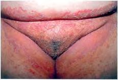 4 Bowen s disease (squamous cell carcinoma,