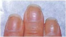 5 Disorders of the nails Figure 5.