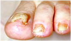 Disorders of the nails 39 Figure 5.