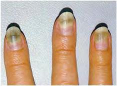 vera. DLP ID: nail pigment, drug induced 4222 Figure 5.