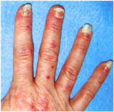 Disorders of the nails 41 Figure 5.