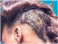 DLP ID: traction alopecia 3860 Figure 6.