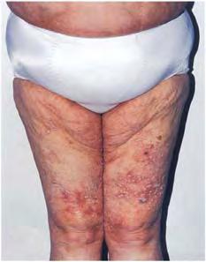 Atlas of women dermatology: from infant to maturity 64 Figure 7.