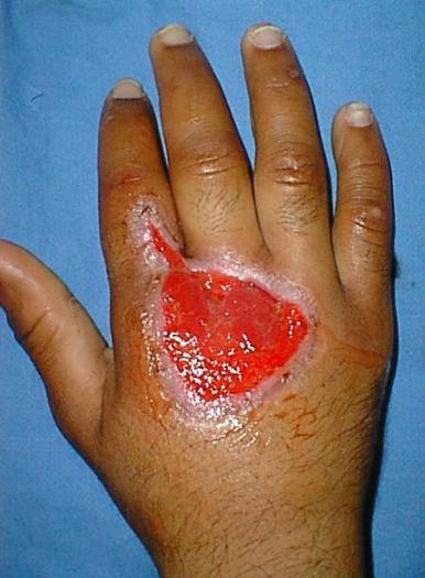 co-morbid conditions Donor Site Selection Skin graft (STSG) STSG 0.
