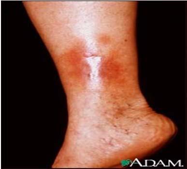 normal to warm Infection, cellulitis, inflammation (Quick Assessment of Leg Ulcers, WOCN, 2009) 73