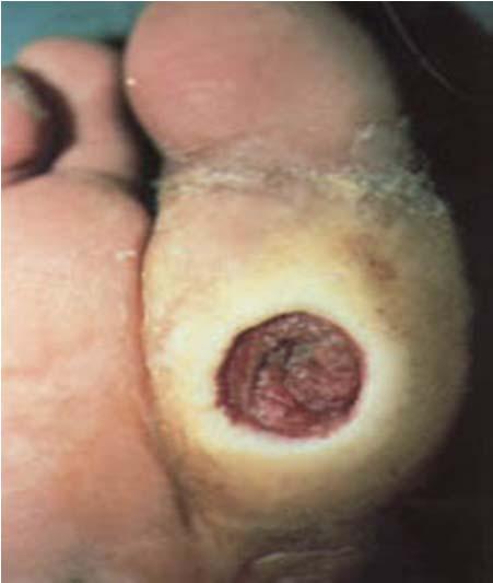 Ulcer or Surgical Wound? Frequently, ulcers are covered by callus or fibrotic tissue.