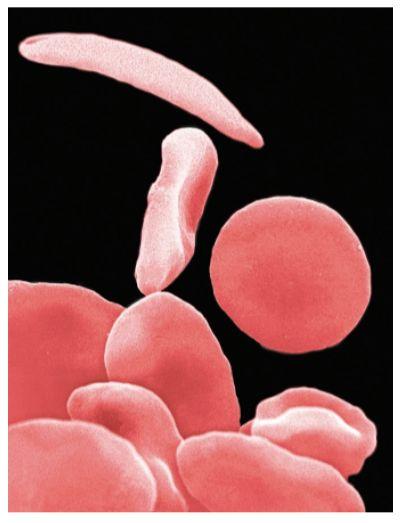 Anthropology example Sickle-cell anemia: genetically inherited blood disease