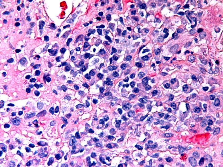 Plasma Cell Hepatitis 1.