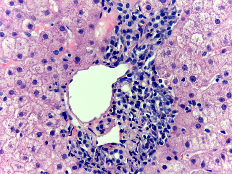 Moderate to severe interface hepatitis plasma cells spilling over into