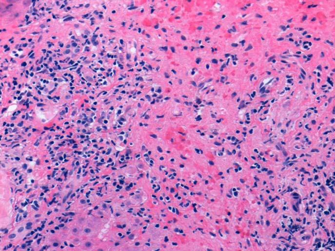 Histological features: Portal inflammation Numerous plasma cells Interface