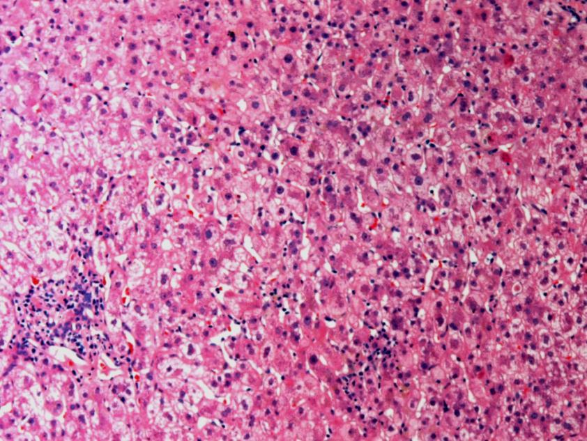 A 57 yo man, 7 months post liver transplantation for hepatitis C cirrhosis, presented with abnormal liver enzymes: