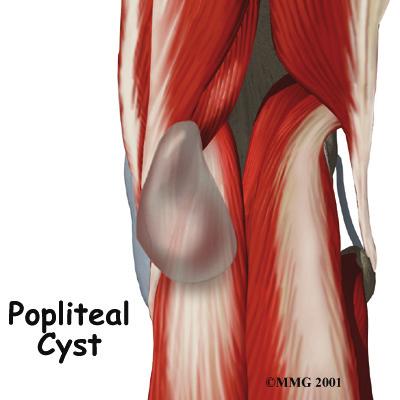 Introduction A popliteal cyst, also called a Baker's cyst, is a soft, often painless bump that develops on the back of the knee. A cyst is usually nothing more than a bag of fluid.