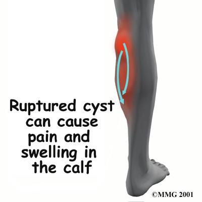 This can lead to a bulging of the joint capsule, much like what occurs when an inner tube bulges through a weak spot in a tire. The cyst may become larger over time.