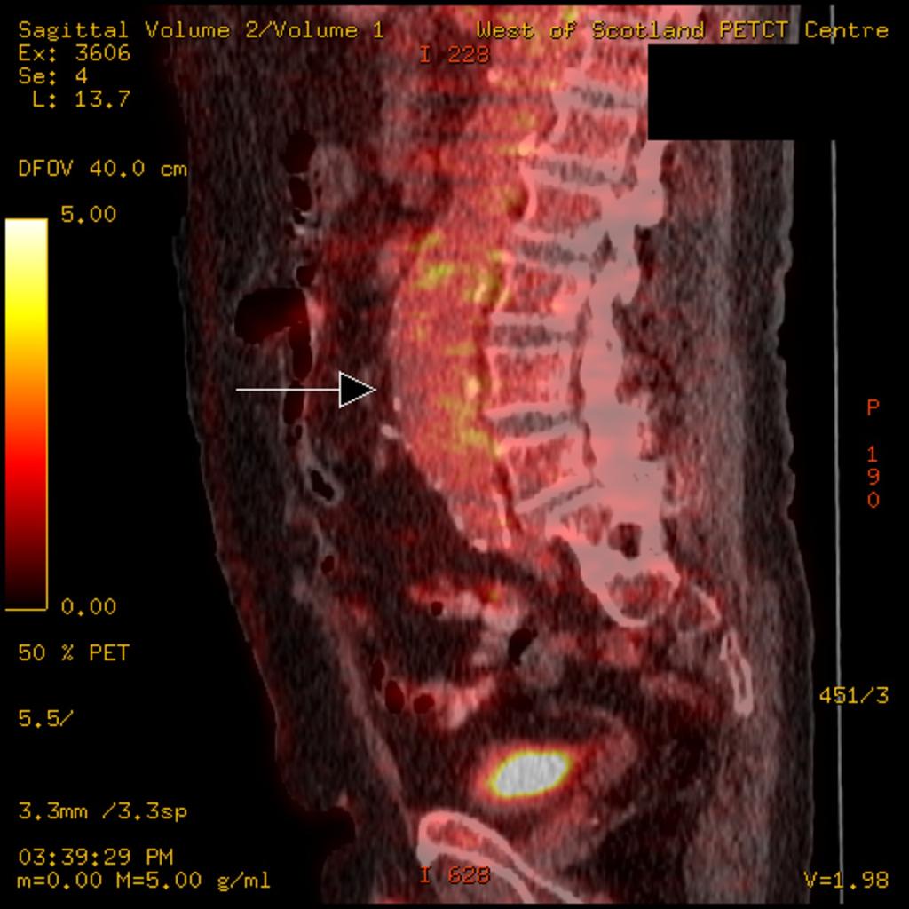 Fig. 4: Sagittal fused FDG PET-CT image showing the typical appearance of an abdominal aortic aneurysm