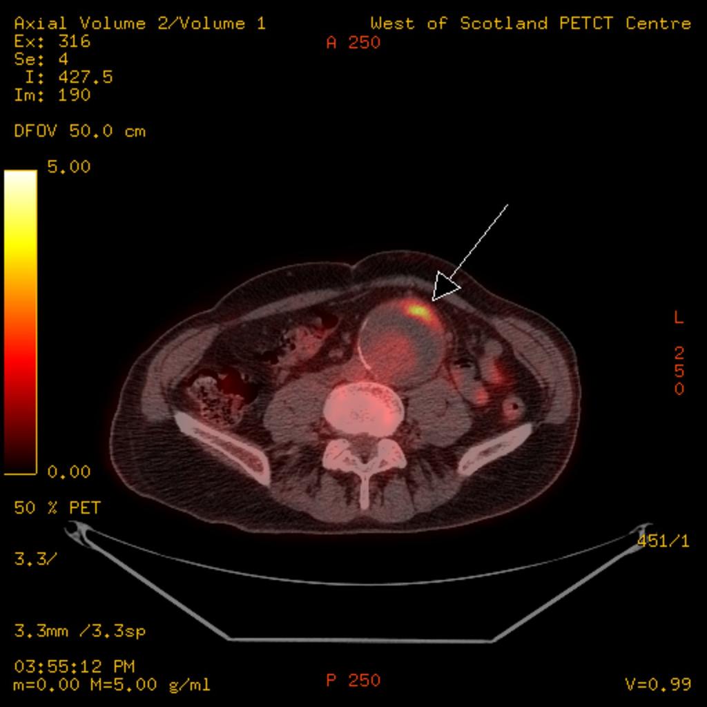 Fig. 5: Transverse fused FDG PET-CT image showing a 64 mm AP diameter abdominal aortic aneurysm in