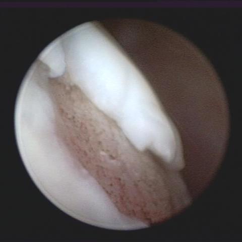 Shoulder Osteochondrosis Site Caudal Humeral Head Diagnosis