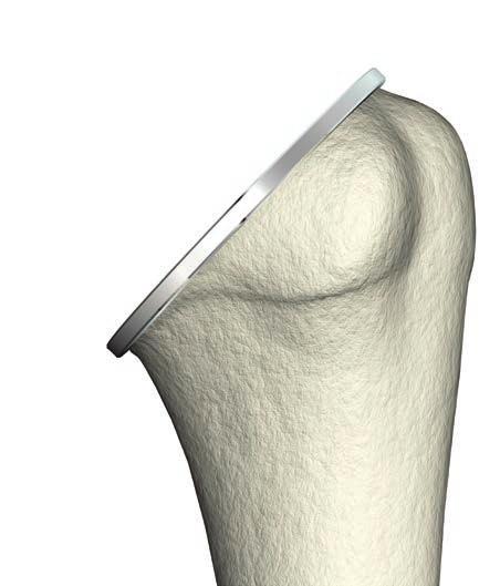ReUnion TSA Shoulder System Operative technique Humeral preparation Option A Option B Figure 46 Humeral protector plate There are two existing Humeral protector plates available,