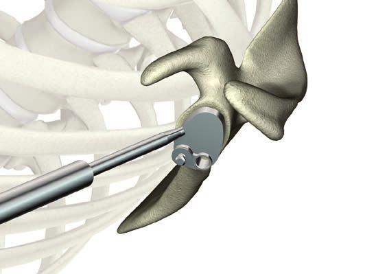 ReUnion TSA Shoulder System Operative technique Pegged glenoid preparation Take the variable angle glenoid drill and drill