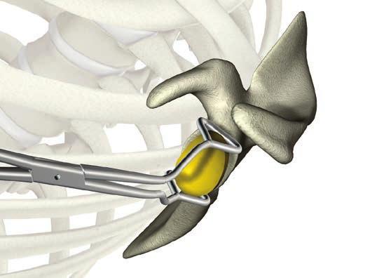 Figure 102 If trialing the entire total shoulder construct prior to cementing is preferred, the desired size single radius head can be placed on the humeral broach within the canal, and the fit of