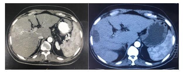 After radioembolization the tumor is hypodense and decreased in size (C,D) Case 2: 68 year old male showing