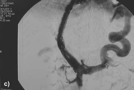 (c) Angiographic imaging through the 9 Fr TIPS sheath after TIPS creation with three overlapping stents deployed, one intrahepatically, one in the main portal, and one in the splenic vein.