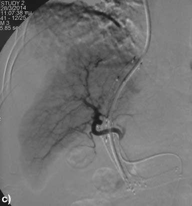 and another same type bare stent of 10 60 mm in the distal splenic vein for straightening of the portal stent towards the splenic axis. Five thousand IU of heparin was intravenously administered.