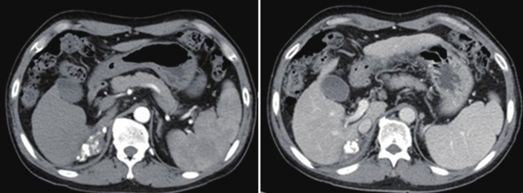 Computed tomogrphy of the liver showed lesion with n incresed Lipiodol uptke nd decresed tumor volume (A). The tumor thrombus ws not observed in the right min portl vein ().