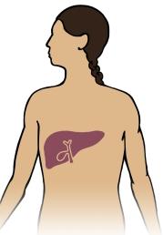 What is hepatitis C? Hepatitis C is a virus that causes damage to the liver.
