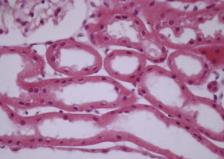 Tubulo-interstitial Fibrosis Occlusive