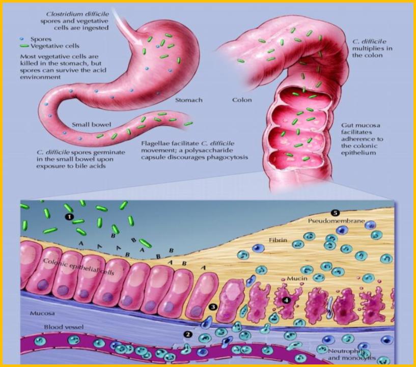C. diff Pathophysiology Lives in environment in spore form Spread fecal-oral Spores can srvive gastric environment, colonize intestines Gt flora altered C.