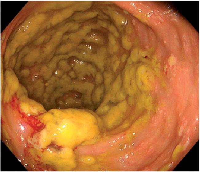 diff Infection clinical otcomes: Diarrhea