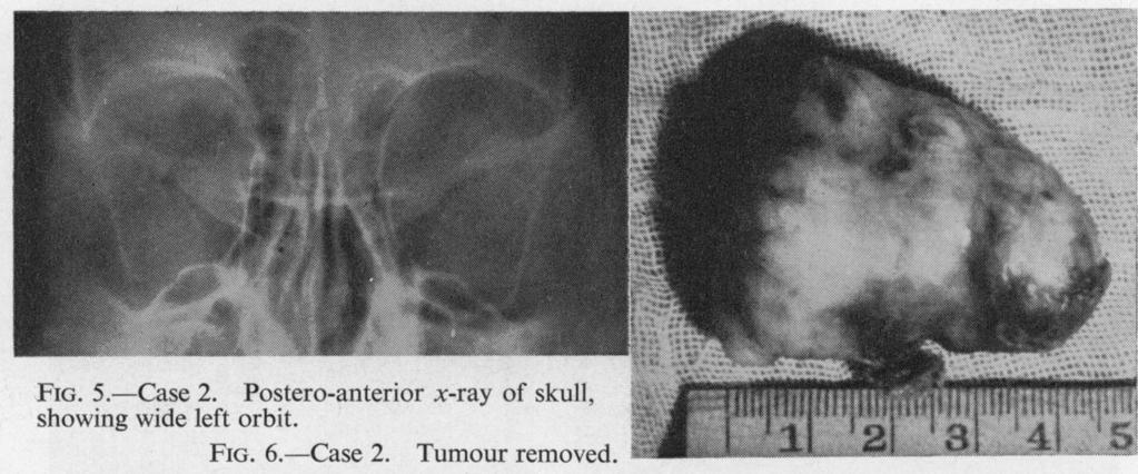 166 AL Y MORTADA segmented 54 per cent. (total polymorphs 60 per cent.), lymphocytes 34 per cent., monocytes 4 per cent. A postero-anterior x ray of the skull (Fig. 5) showed a dilated left orbit.