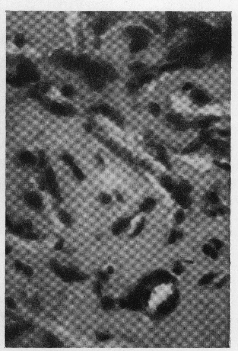 ORBITAL BENIGN HAEMANGIO-ENDOTHELIOMATA FIG. 7.-Case 2. Concentric arrangement FIG. 8.-Case 2. Proliferating endothelial cells of proliferating endothelial cells surround- surrounding neoplastic capillaries.