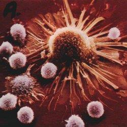 Scanning electron microscope pictures shows killer t-cells attacking the cancer cell. Notice the tentacles of the cancer cell.